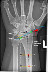 Image result for Wrist XRay