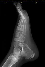 Image result for Calcaneal Apophysitis
