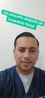 Ejercicio para Ojo Pequeño Tras Parálisis Facial