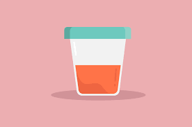Kondisi kencing berdarah disebut juga dengan istilah hematuria, hematuria urine yang normal seharusnya tidak mengandung darah sedikitpun, kecuali pada wanita yang sedang menstruasi. Urine Berdarah Hati Hati Hematuria