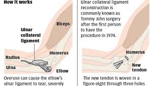 Reconstruction of the ulnar collateral ligament, or ucl, got its nickname from john, the los angeles dodgers pitcher who first had the procedure in 1974.during. Baseball S New Age Epidemic Tommy John Surgery St Louis Cardinals Stltoday Com