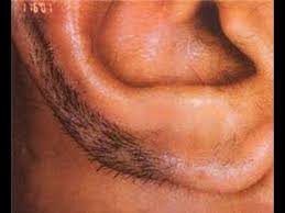 Medical electrolysis devices destroy hair growth with a shortwave radio frequency after a thin probe is placed in the hair follicle. Facebook