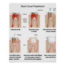 Root Canal Treatment Poster Zazzle Com Root Canal Treatment Root Canal Treatment Poster Root Canal