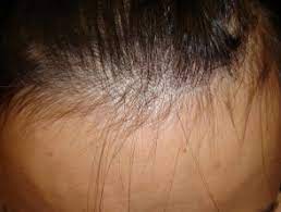 At first my gp thought it might be an underachieve thyroid and am on thyroxine for that as it was borderline, but on looking up the internet, it shows that rivaroxaban, eliquis, apixaban, and two other which i can remember, but begin with o and d (sorry) all cause hair loss. Alopecia From Drugs Dermnet Nz