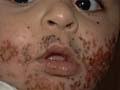 Principles of Pediatric Dermatology
