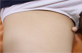 A Pedunculated Mass On The Thigh Photo Quiz American Family Physician