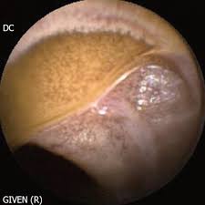 Image result for Intestinal Enteropathy