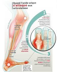 Cette technique est également appliquée régulièrement à la cheville. La Goutte Une Maladie Plus Complexe Qu Il N Y Parait