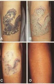 Tattoo Removal 50 Do You Have Tattoos That You Would Like To Get Rid Of We Have The Best Technology In Tattoo Removal Tatuajes Modelos De Tatuajes Fotos