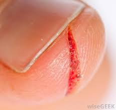 Check spelling or type a new query. What Is Sepsis With Pictures