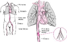 La trombosis es un fenómeno patológico por el cual una vena o una arteria del aparato circulatorio se obstruye por un trombo, que es una especie de tapón formado por. Trombosis Venosa Profunda Trastornos Del Corazon Y Los Vasos Sanguineos Manual Msd Version Para Publico General