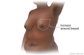 Image result for Mastectomy