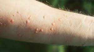 Lice bites are tiny red skin spots on the. What Bit Me How To Identify Common Bug Bites Everyday Health
