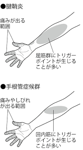 手指や手首が痛い 腱鞘炎 手根管症候群 はテープ整体で治せる人も 原因は 腕のしこり カラダネ 手根管 手根管症候群 腱鞘炎