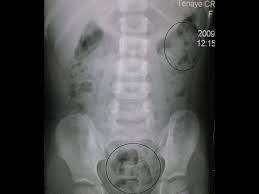 Image result for Plecanatide