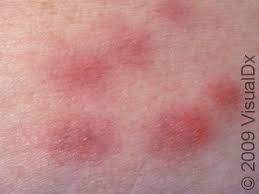 Image result for erythema nodosum