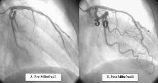 Image result for Mibefradil