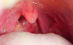 Image result for Uvulitis