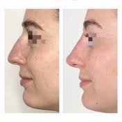 Non-Surgical Rhinoplasty