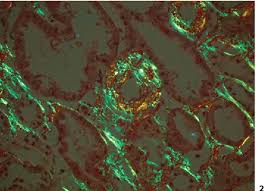 Material does not take up. Figure 1 From Al Amyloidosis With Renal Involvement Semantic Scholar
