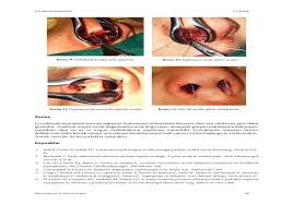 Guncel Burun Ve Sinus Cerrahisi Flip Book Pages 51 100 Pubhtml5