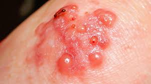 Image result for Fire Ant Sting