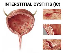 Image result for Interstitial Cystitis