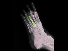 Image result for Metatarsal