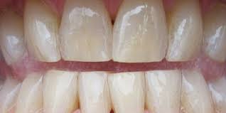 Image result for Tooth Discoloration