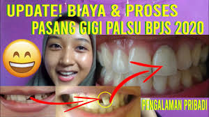 Check spelling or type a new query. Crowngigi Pasang Gigi Palsu Pakai Bpjs 2020 Pasanggigipalsubpjs Youtube