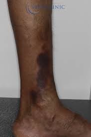 Image result for Pigment stains on the shin