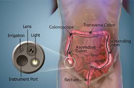 Image result for Colonoscopy in GI Bleeding