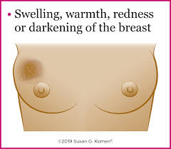 In a small number of cases it is linked to a disease that is associated with breast cancer called paget's disease. Warning Signs Of Breast Cancer Do You Know What To Watch For