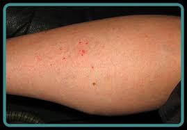 Bird Mites In Hair Pictures Of Mites On Humans Healthtopquestions Htq In 2020 Mites On Humans Mites Demodex Mites