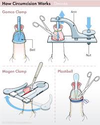 The most common clinical indication for circumcision was phimosis (75% of patients). Adult Teen Circumcision Los Angeles Cedars Sinai Suture Free Needle Free Injection Natural Sedation Shang Ring