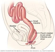 Ileoanal Anastomosis Aka J Pouch What Replaced My Colon Colectomy Colitis Ulcerative Colitis
