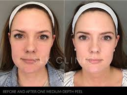 Among these ingredients, you will find salicylic acid but you should make sure that you used tca before, in similar concentrations. Slk Nashville Chemical Peels For Sun Spots Brown Spots And Melasma