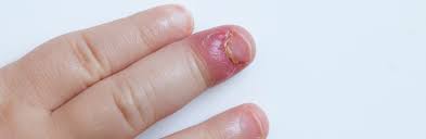 Nagelbettentzundung Symptome Behandlung Hausmittel Mooci