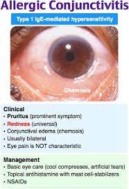 Allergic Conjunctivitis Nurse Practioner Medical Mnemonics Nursing Mnemonics