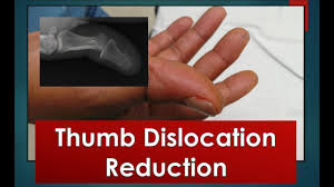 When a joint is dislocated, the normal alignment of the finger is altered, and the joint must be put back into place. Thumb Dislocation Reduction Youtube