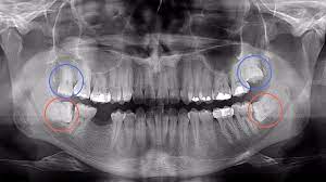 Dente Do Siso Nascendo Deitado E Inflamado Socorro Dr Paulo Coelho