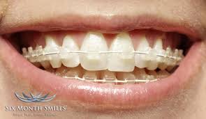 If you whiten your teeth with braces on you'll most likely end up with spots from the bleach only getting on the exposed enamel. How To Keep White Braces Clean Birchgrove Dental