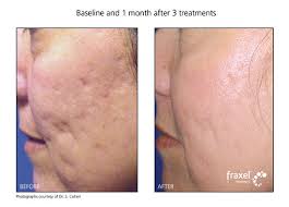 When you're ready, book a consultation. Acne Scars Philadelphia About Face Skincare