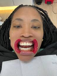 Okay No filter …. Dr Sebastian Cali Colombia $4800 5days Flight not  included I got 2 bridges All are EMax Porcelain  https://www.instagram.com/drsebastianmanzano?igsh=MzRlODBiNWFlZA==