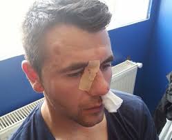 Au dat în mine ca într-un animal“: Arbitrul Marian Carson, operat după  bătaia primită la un meci jucat la Ovidiu