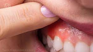 Sonda Clinica De Periodoncia E Implantologia Oral Pregunta Me Salio Una Bolita En La Encia Facebook