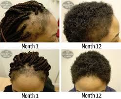 Hair Loss Success Story Patient Successfully Treated For Traction Alopecia At The Belgravia Ce Natural Hair Growth Tips Black Hair Growth Natural Hair Growth