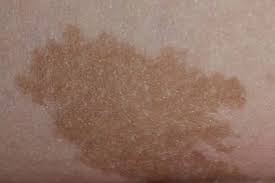 Taking out a small piece of tissue to see if there are cancer cells in it. When To Worry About Moles On Your Child Different Types And Skin Cancer Risks Lifestyle News Asiaone