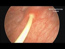 Curl present at end portion of the stent is of flexible in nature to allow uncurling of the stent and its removal in an easy way. Removal Of Double J Stent By Cystoscopy Youtube