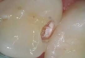 Regular dental visits and good brushing and flossing habits are your best protection against cavities and tooth decay. What Does A Cavity Look Like Mint Hill Dentistry